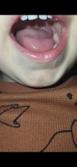 Red patches ans lumpy tongue?