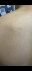 Burst blood vessels/Petichiae on DS back?