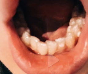 Experiences of Invisalign 