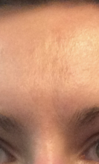 Anyone else undecided about whether to Botox?