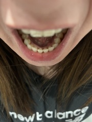 Gum lump - PHOTOS INC