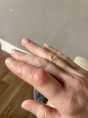 Rheumatoid arthritis?