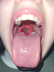 Red patch on throat...paranoid?? (TW: graphic issues)