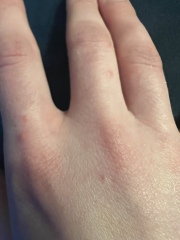 Name this rash 