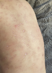 Help - anyone else seen chicken pox this bad?