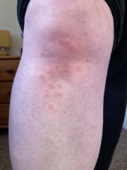 Does anyone know what these bites are?
