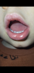 Red patches ans lumpy tongue?
