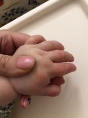 Sore red patches on hands