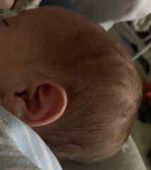Worried sick. Is this craniosynostosis ?!