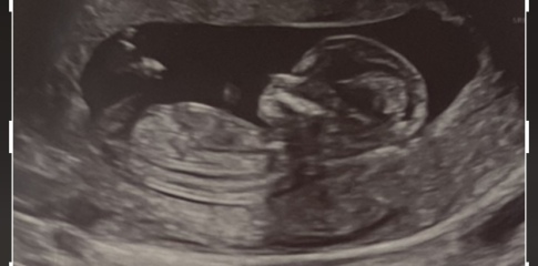 Do you think 4d scans are worth it?