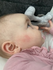 Little girl has woken up with rash on face? Pictures