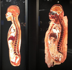 Most horrifying facts about obesity?