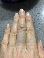 Achenbach syndrome - help, please!