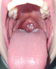 Red patch on throat...paranoid?? (TW: graphic issues)
