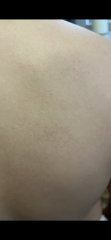 Burst blood vessels/Petichiae on DS back?