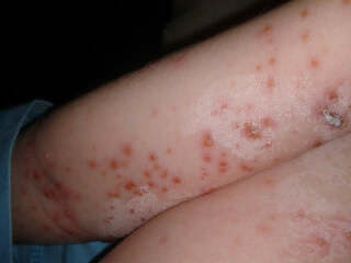 Help - anyone else seen chicken pox this bad?
