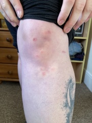 Does anyone know what these bites are?
