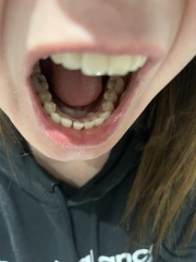 Gum lump - PHOTOS INC