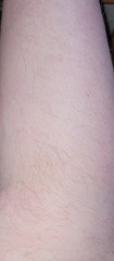 Will a lumea work (with hairy leg pics)?
