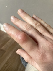 Rheumatoid arthritis?