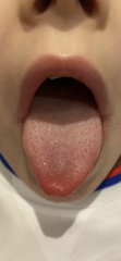 Query Strep