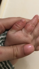 Sore red patches on hands
