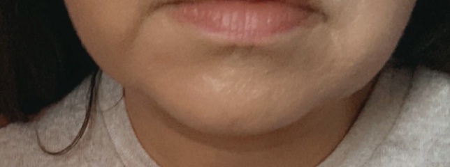 Face lift at 36? (pics included )
