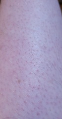 Will a lumea work (with hairy leg pics)?