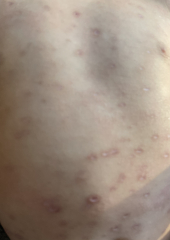 Help - anyone else seen chicken pox this bad?
