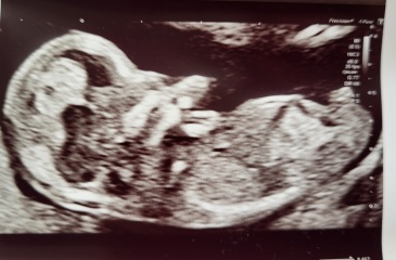 Nub theory - boy or girl? :-)