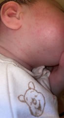newborn acne?!