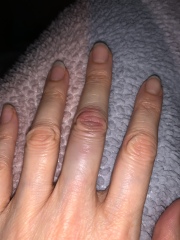 Achenbach syndrome - help, please!