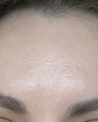 Anyone else undecided about whether to Botox?