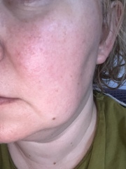 Rosacea or make up allergy?