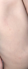 Hives? Or something else?