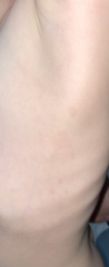 Hives? Or something else?