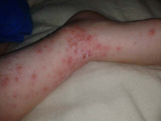 Help - anyone else seen chicken pox this bad?