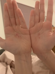 Itchy marks on palms
