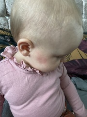 Little girl has woken up with rash on face? Pictures