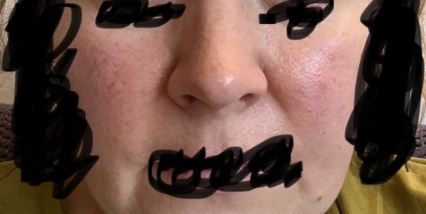Rosacea or make up allergy?