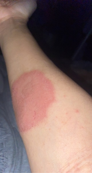 Skin fungal infection