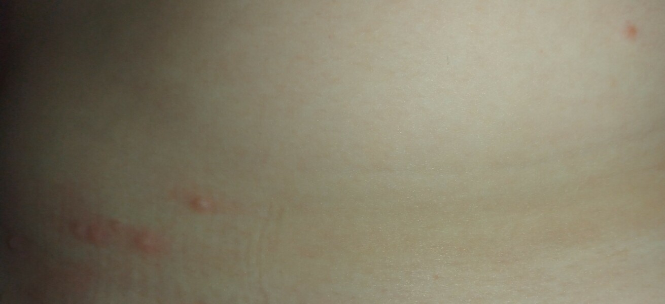 Chickenpox? Pics?