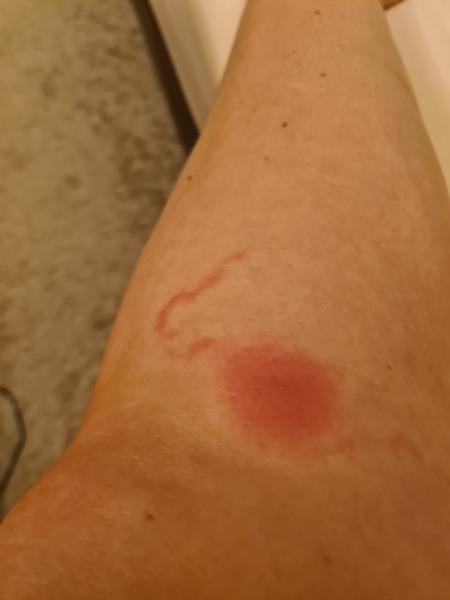 Insect bite. Infected?