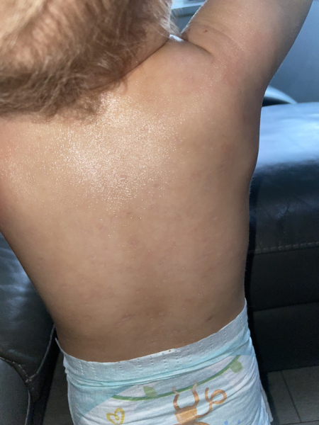 Help- how can I stop my sons awful case of chicken pox scarring