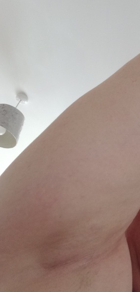 Armpit Lump