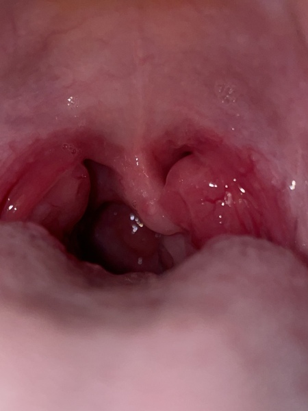 How concerned would you be by these tonsils (pic) 