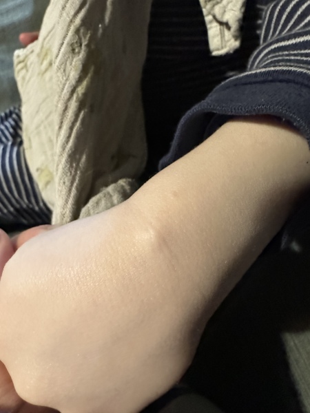 What is this bump in DS arm?