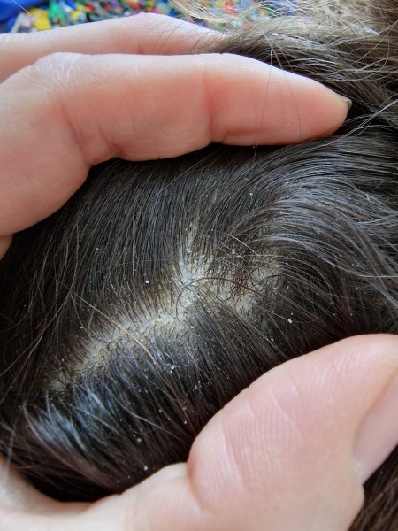 Dandruff or cradle cap? 