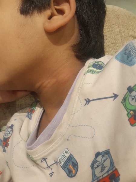 Hives after viral infection 5 year old DS