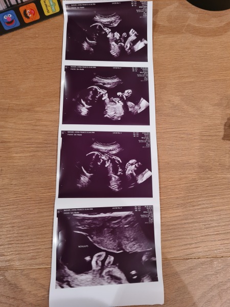 20 week scan photo gender slip up